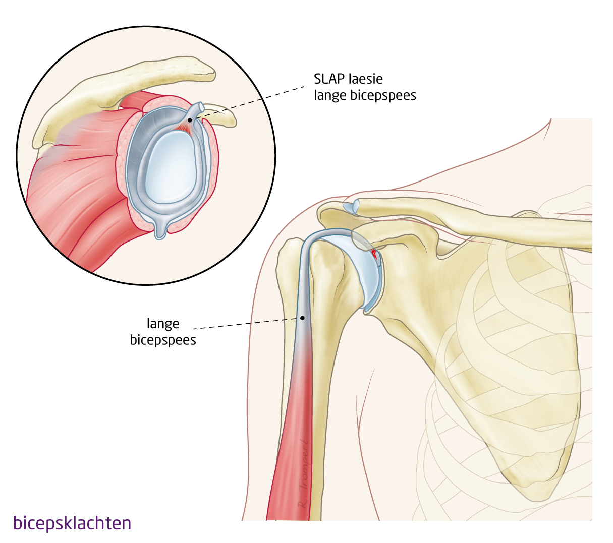 OCON - Aandoening: Bicepsklachten (tendinitis, scheur,