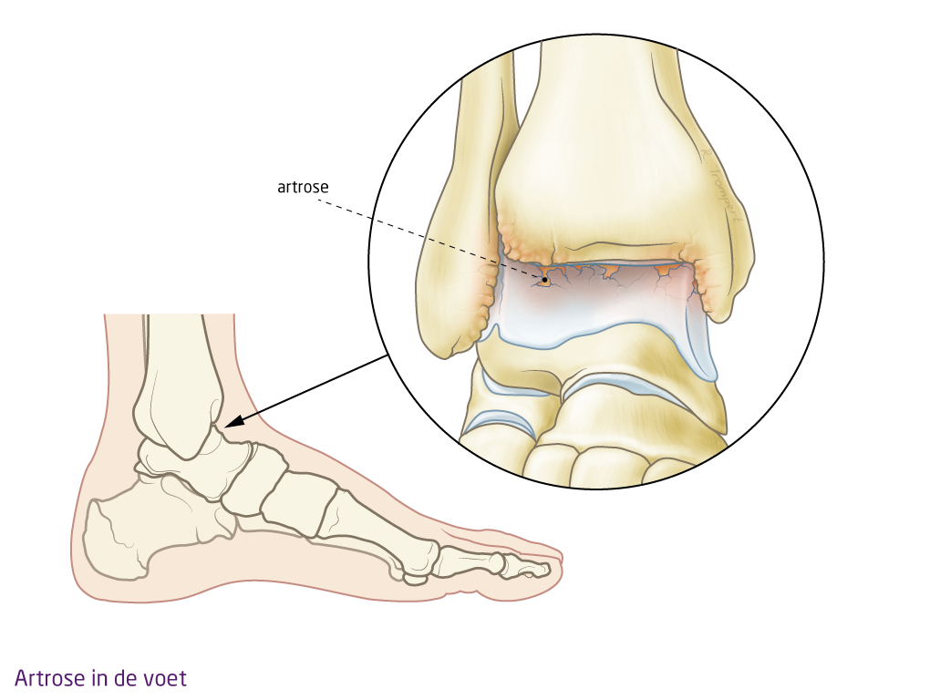 OCON - Artrose voet, enkel