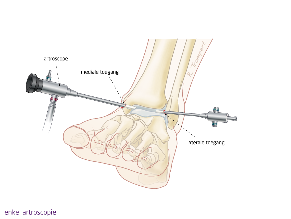 bovenste portemonnee Retentie OCON - Aandoening: Artrose voet, enkel